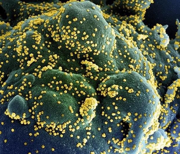Một tế bào (xanh dương/xanh lục) bị nhiễm nặng các hạt virus SARS-CoV-2 (màu vàng), được phân lập từ mẫu của bệnh nhân COVID-19. (Ảnh: AFP/TTXVN).