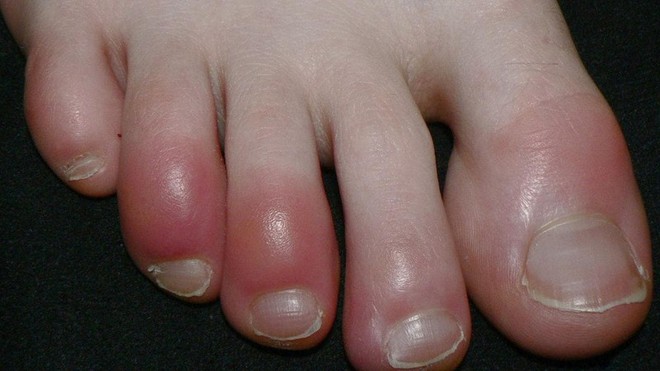 Một bệnh nhân mắc chứng cước ngón chân. Ảnh: Wikipedia.