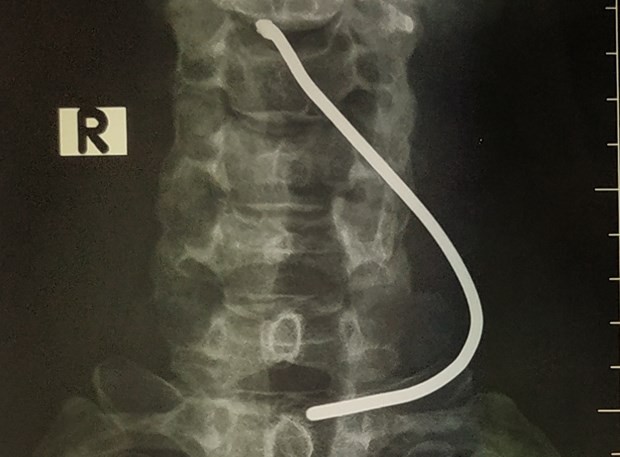 Hình ảnh chiếc thanh sắt cắm vào cổ bệnh nhân. (Ảnh: PV/Vietnam+).