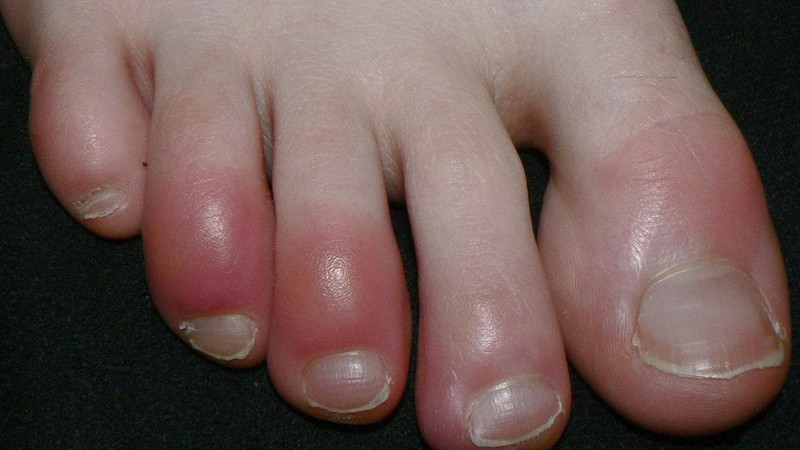 Một bệnh nhân mắc chứng cước ngón chân. Ảnh: Wikipedia.